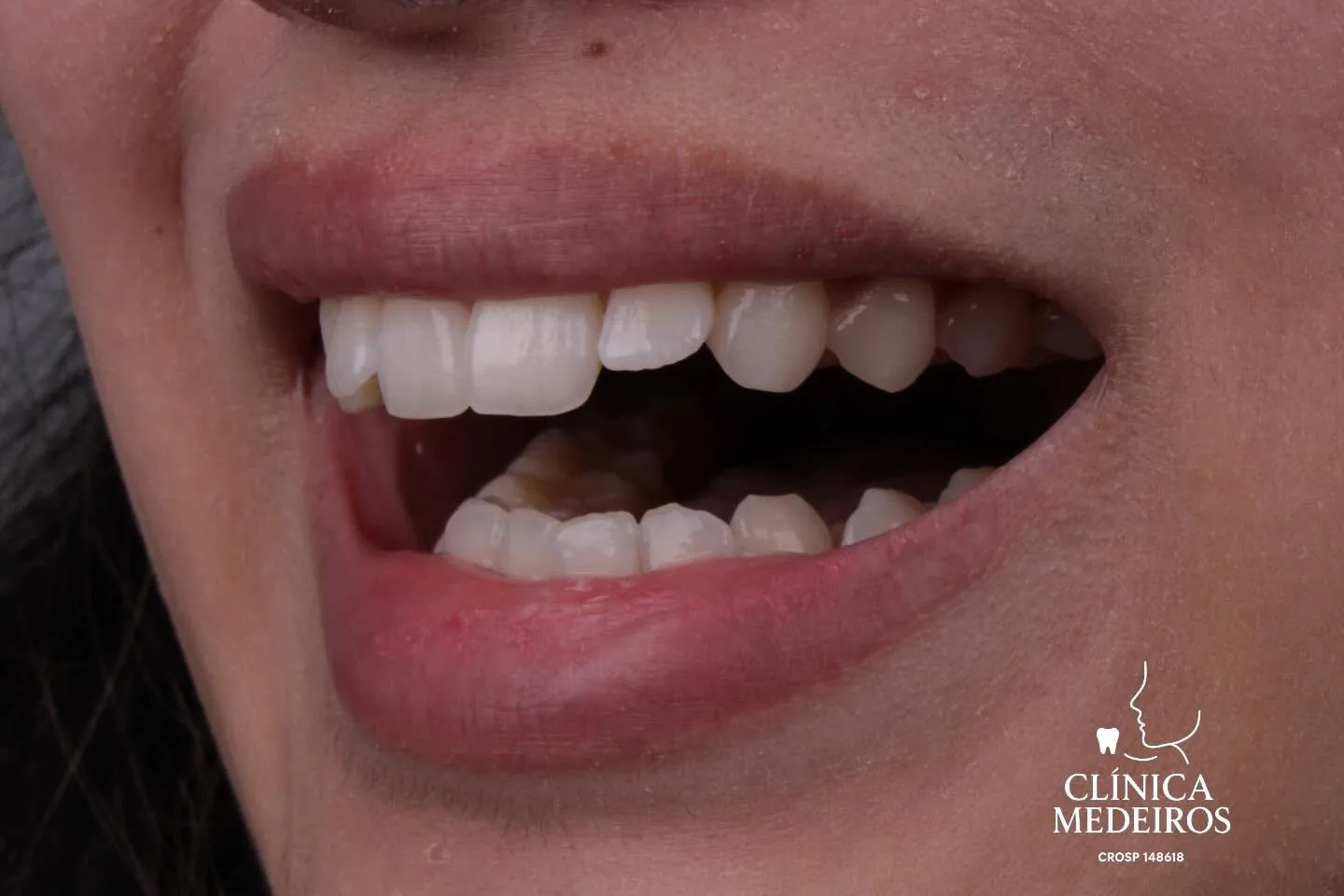 Antes: dente frontal fraturado e desalinhado