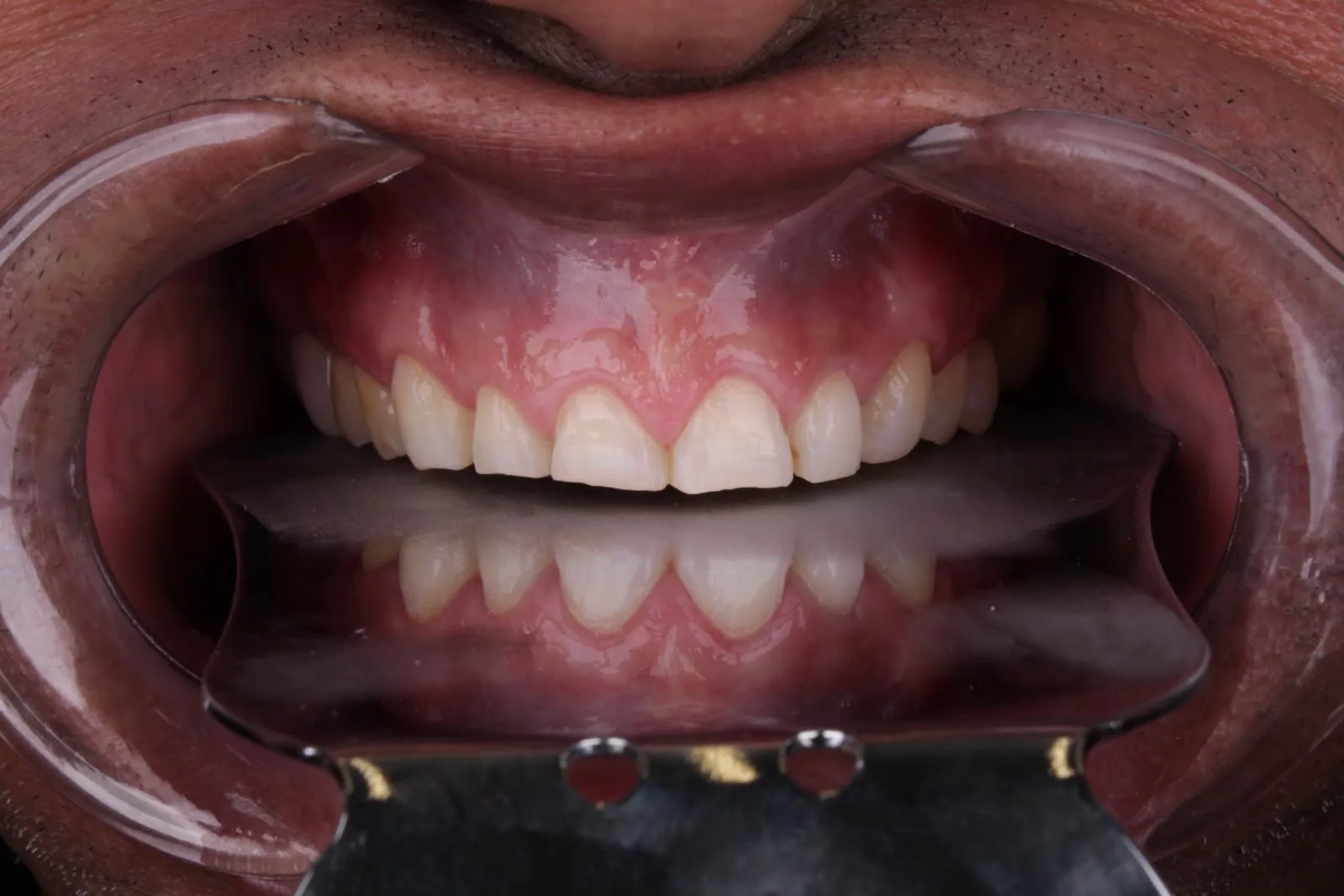 Registro clínico antes do tratamento: dentes fraturados, desgastados e com cor irregular