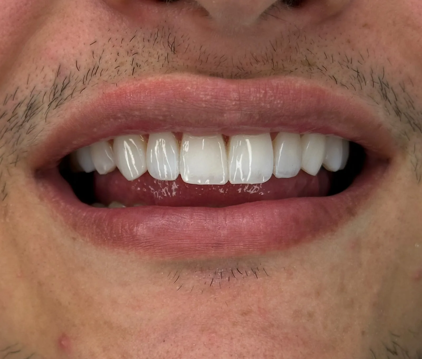 Depois: novo sorriso com lentes em resina uniformes em paciente masculino
